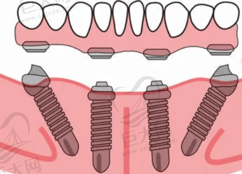 all on 4种植牙