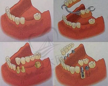 牙齿缺失的修复方案