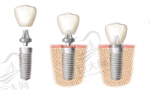 种植牙2