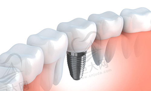种植牙4