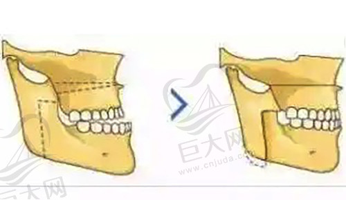 引导面部颌骨生长发育