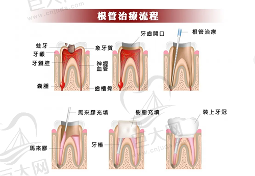 根管治疗步骤