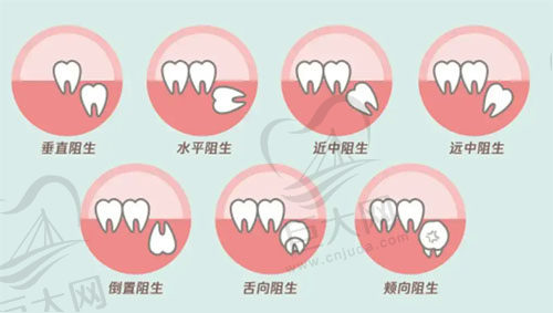 智齿的类型