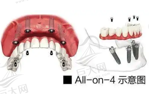 all on 4种植牙