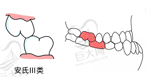 肌能性安氏Ⅲ错颌示意图