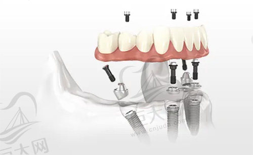 高难度all-on-4种植牙技术