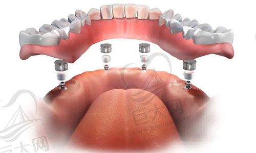 半口全口牙颌种植图片