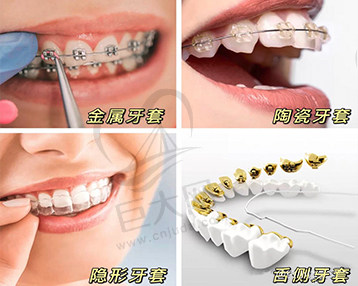 多种牙套矫治方式