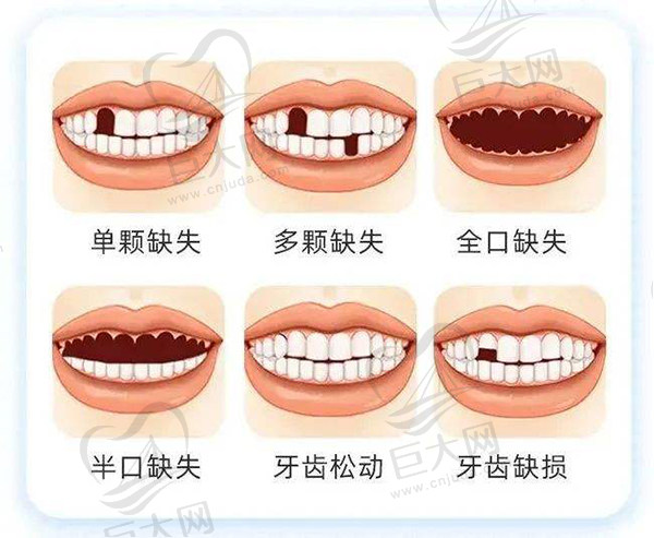 适合做微创种植的人群