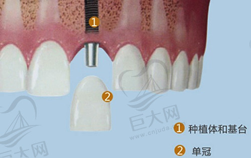 种植牙结构示范图