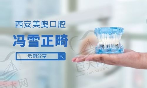 西安美奥口腔冯雪正畸示例分享