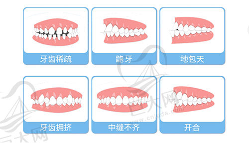 牙齿不齐