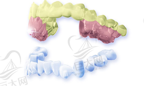 牙齿隐形矫正个性化取模