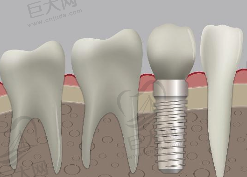 种植牙示意图
