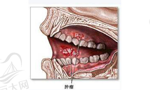 牙龈癌肿瘤