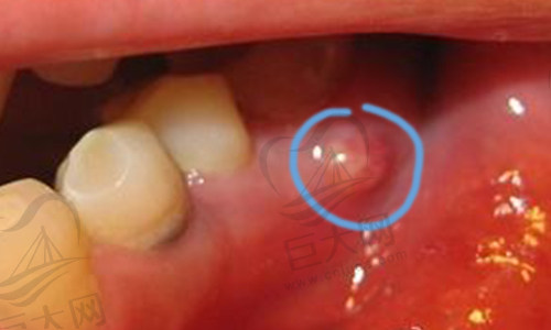 牙龈癌临床症状