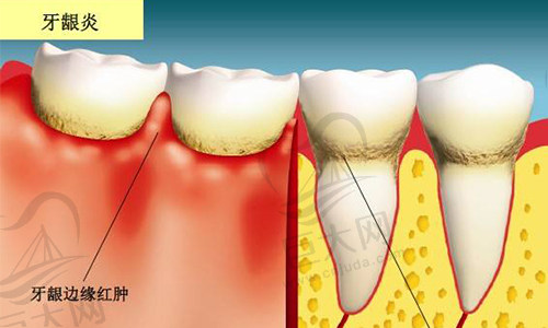 牙龈炎