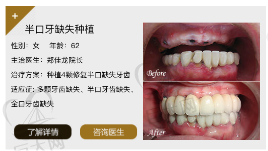 郑佳龙院长半口种植牙病例