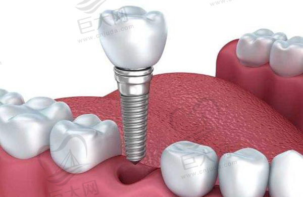 种植牙在国内真实寿命是多少