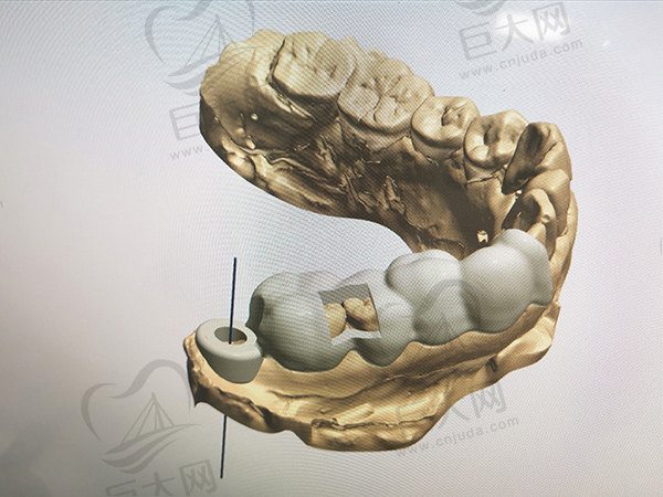 3D数字化导板种植