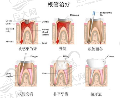 根管治疗