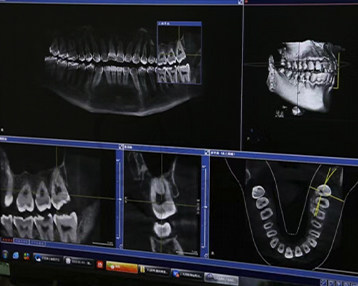 数字化种植牙