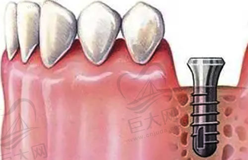 牙齿单颗种植技术