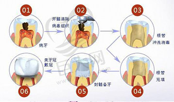 根管治疗流程