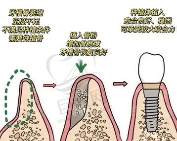 植骨种植是什么