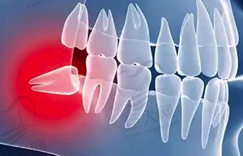 智齿是什么图片示意