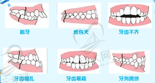 牙齿错颌畸形种类