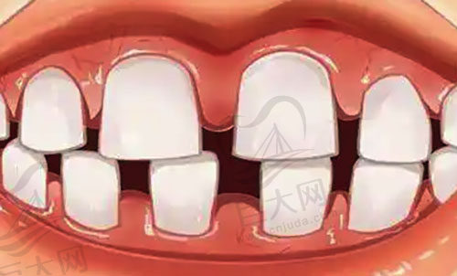 牙齿稀疏导致门牙缝隙大