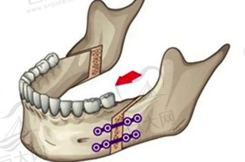 正颌手术示意图