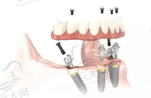 all-on-4种植牙
