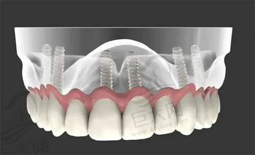 all-on-6种植牙