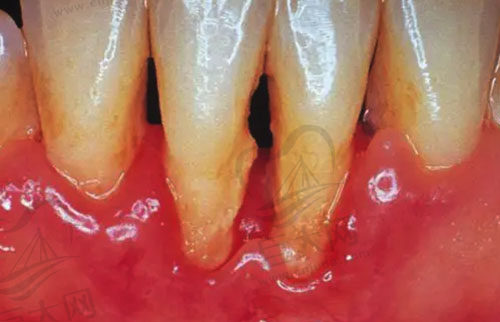 牙周炎导致牙根外露
