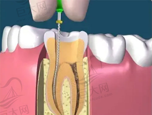 根管治疗
