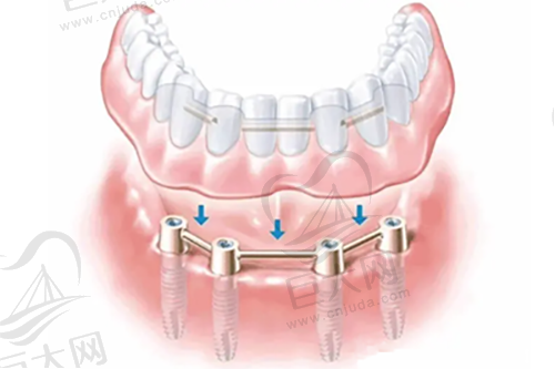 all-on-4种植牙示意图