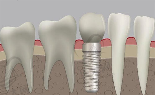种植牙