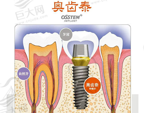 韩国奥齿泰种植体