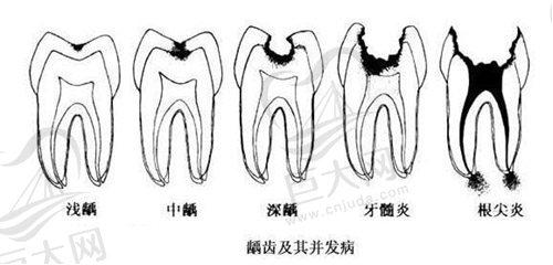 龋齿发展