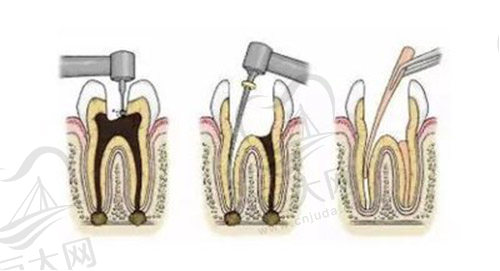 根管治疗
