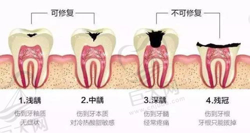 牙齿修复