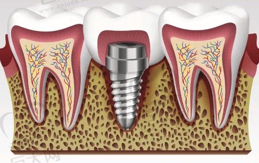 台州椒江牙博士口腔种植牙好不好