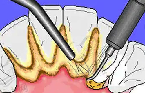 牙结石去除示范图