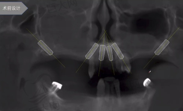 穿翼板种植牙术前设计