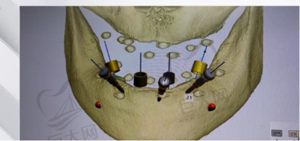 穿翼板种植牙利用3d口腔扫描制作数字导板
