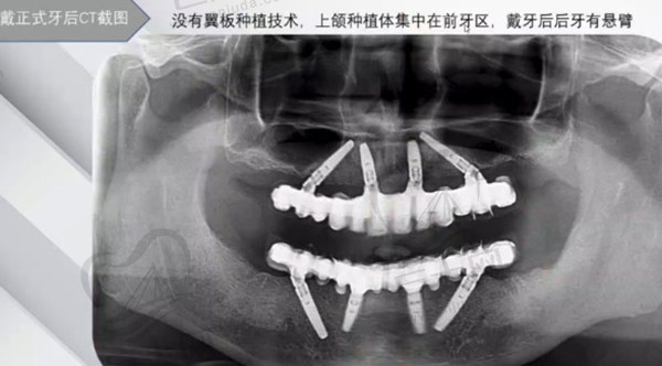 穿翼板种植牙术后，ct图