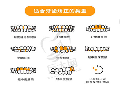 适合牙齿矫正的类型