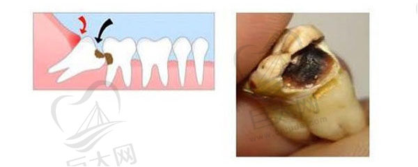 智齿龋坏拔牙
